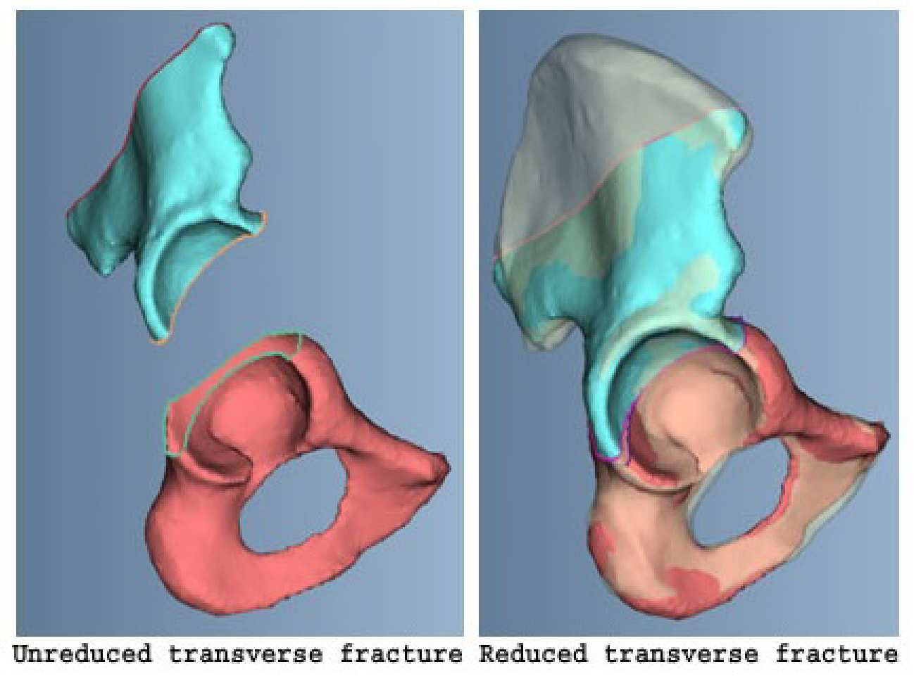 Acetabular Fracture Reduction using a statistical shape model