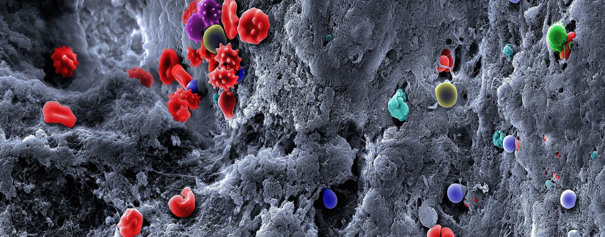 Blood clot