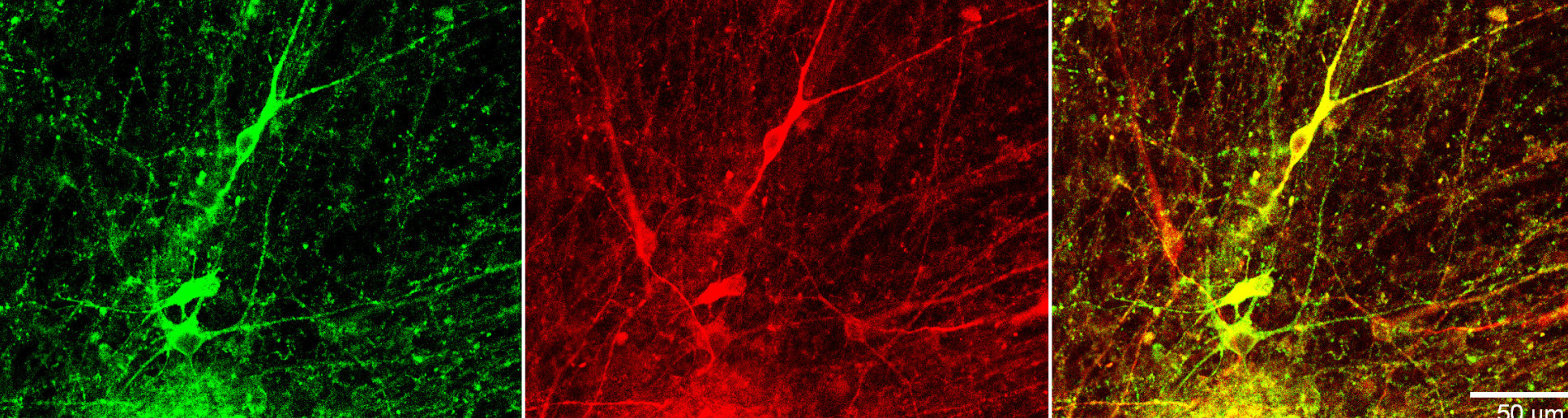 Neurons in a dish derived from Alzheimerâ€™s patients