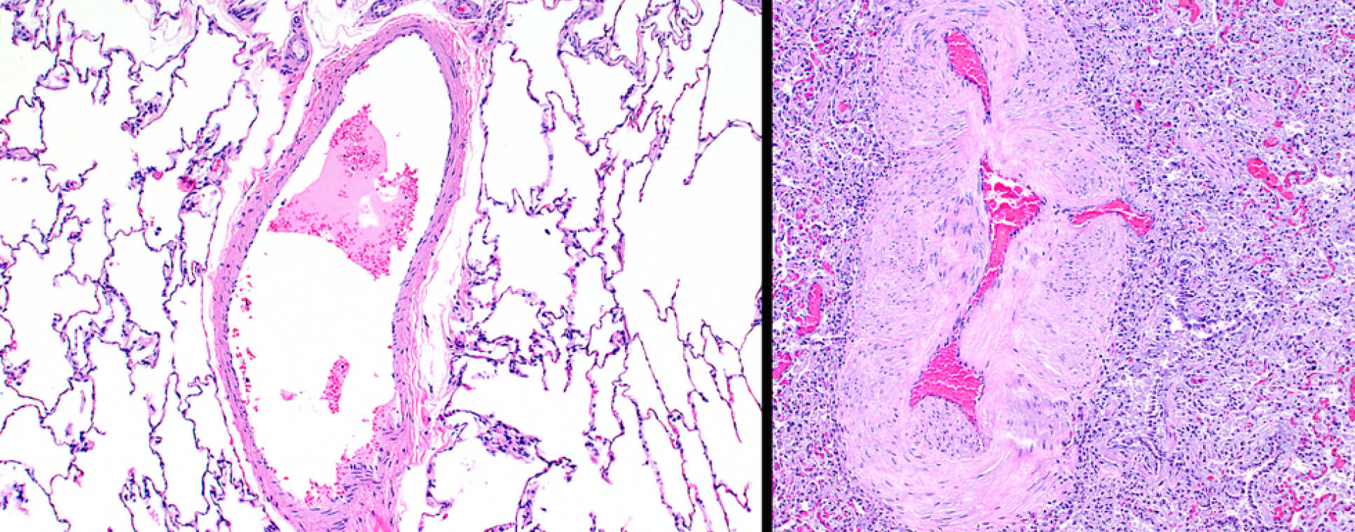 Pulmonary hypertension