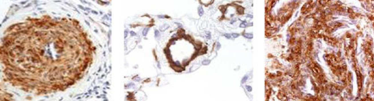 (Left) Proliferation in vascular wall, (Middle) Distal muscularization, (Right) Plexiform lesion