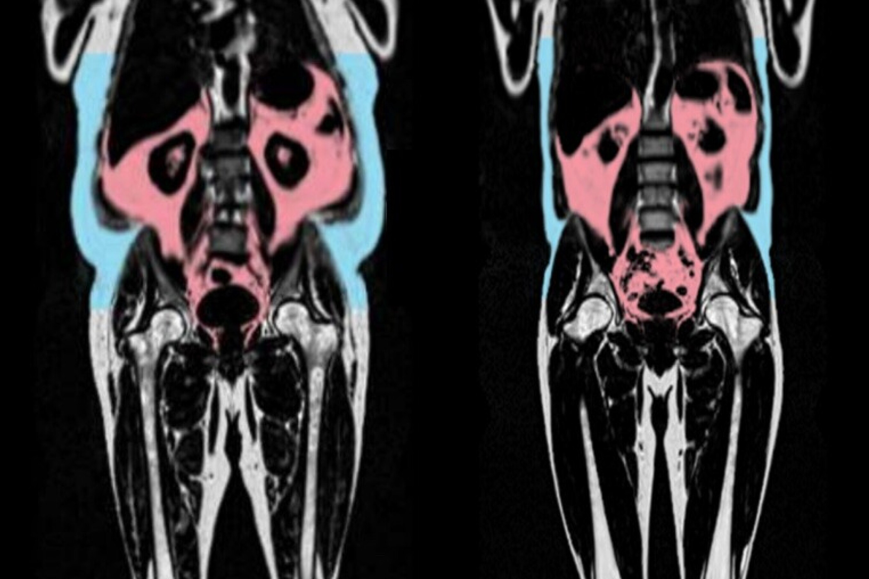 An image of an MRI Scan showing body fat